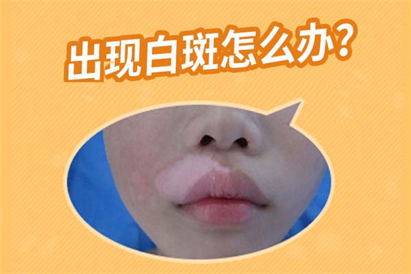 男性白癜风治疗,治疗男性白癜风要注意的